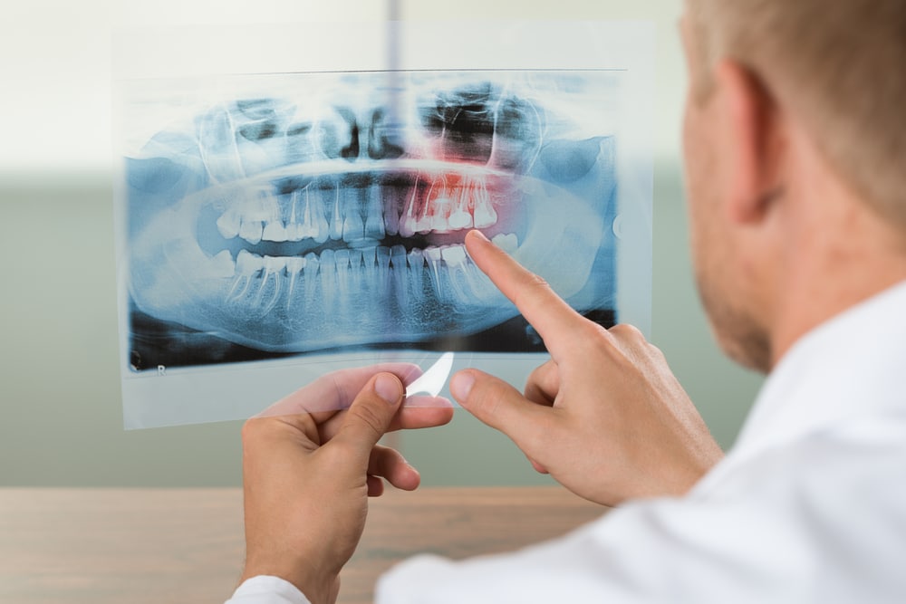 A man assessing an x-ray of his teeth, realizing the increased risk of stroke.