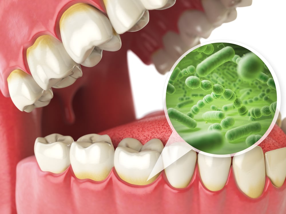 An illustration of bacteria in a tooth by Waco dentist Dr. Sean Endsley.